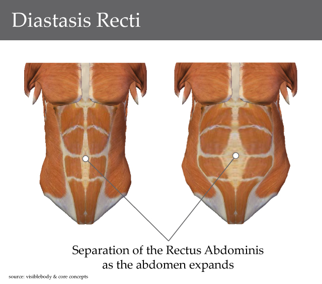 Diastasis Recti Tummy Separation Vanea Posture Pelvic Floor