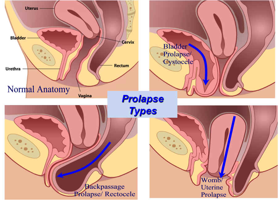 Pelvic Organ Prolapse Vanea Posture Pelvic Floor Exercises